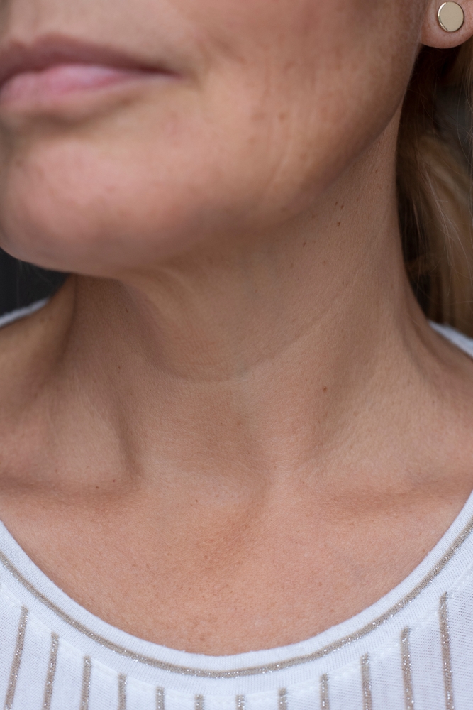 Age-related,Changes,In,The,Face,,Neck,And,Décolleté,,Age,Spots,