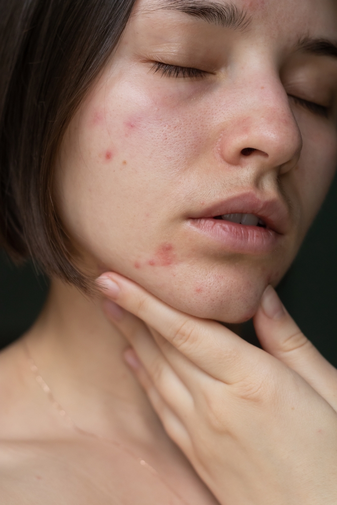 The,Problem,Of,Acne,Pimples,On,The,Chin.,Facial,Skin